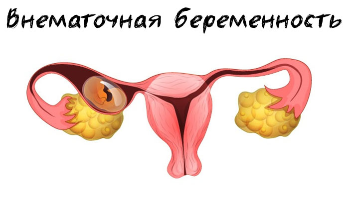 Внематочная беременность признаки на ранних сроках симптомы