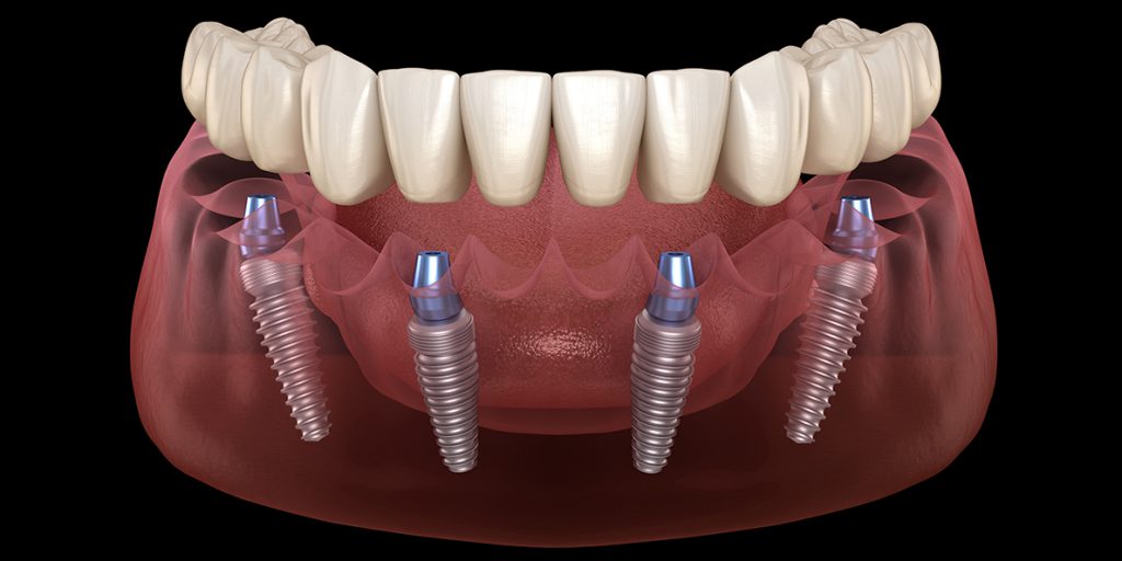 Исправление прикуса или имплантация зубов